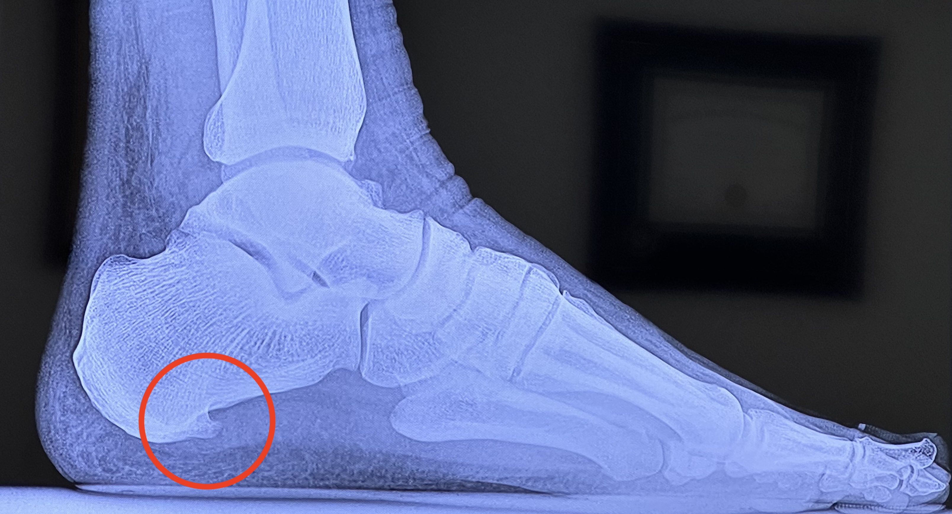 Matt Coneybeare - Marathon 29 - Heel X-Ray Bone Spur